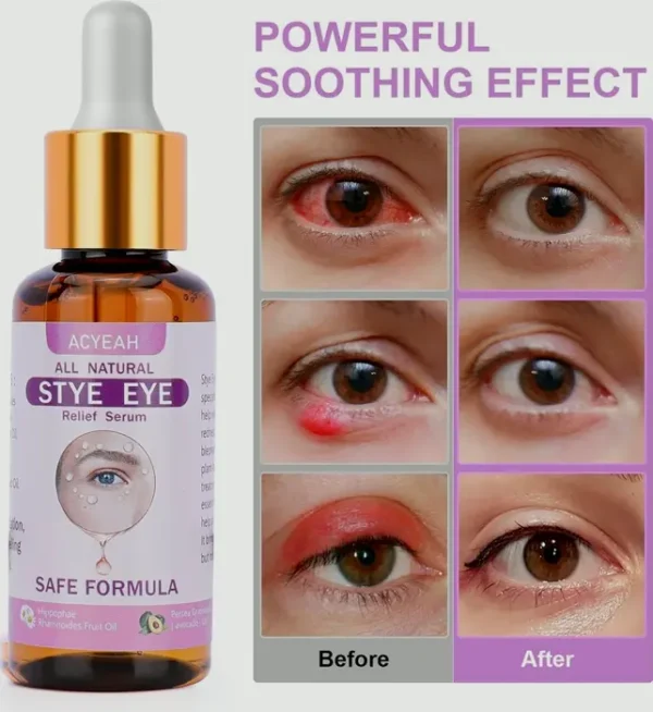Stye Eye Treatment, Fast Relief Solution, 30ML